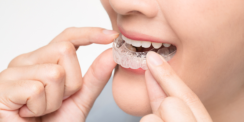 The Path to a Perfect Smile with Invisalign at Élan Dentistry